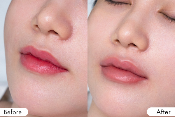 Hình ảnh trước và sau khi xóa xăm môi