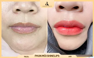 Chị Minh Tuyết – trước và sau