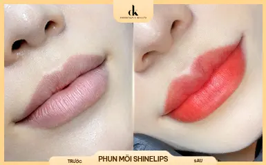 Chị Thu Hà – trước và sau