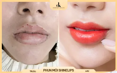Chị Phương Nga – trước và sau