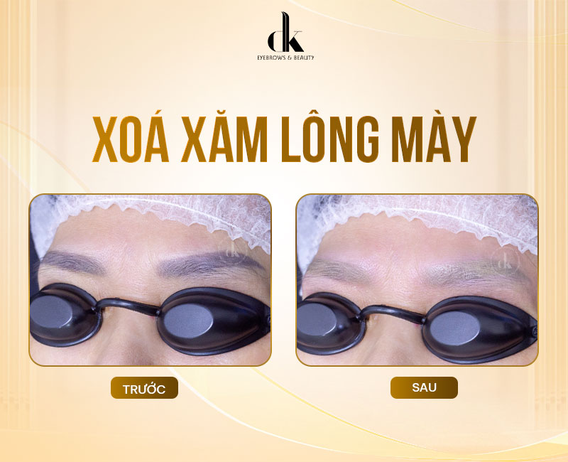 xoa-xam-long-may