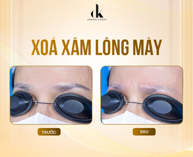 xoa-xam-long-may