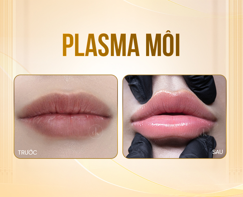 Plasma-moi