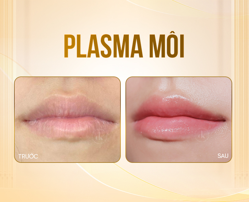Plasma-moi