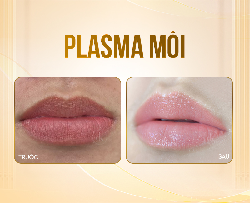 Plasma-moi
