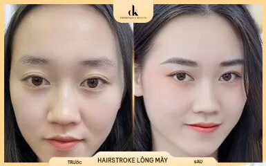 Trước và sau – chị Minh Thu