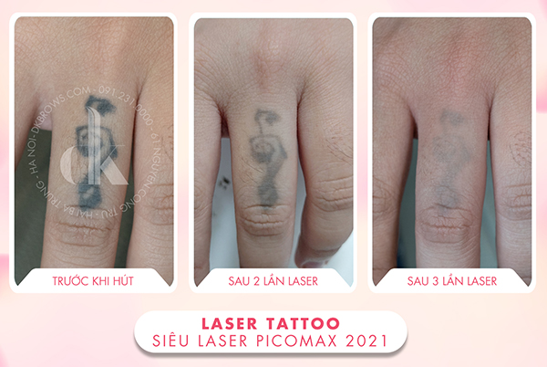 Hình ảnh khách hàng xóa xăm laser ở ngón tay